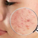 terapia estgen cieszyn problemy skórne