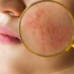 terapia estgen cieszyn blizny potrądzikowe