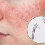 demodex cieszyn diagnostyka skóry