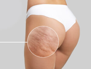 cellulit zabiegi na ciało endermologia arosha presoterapia cieszyn redukcja cellulitu