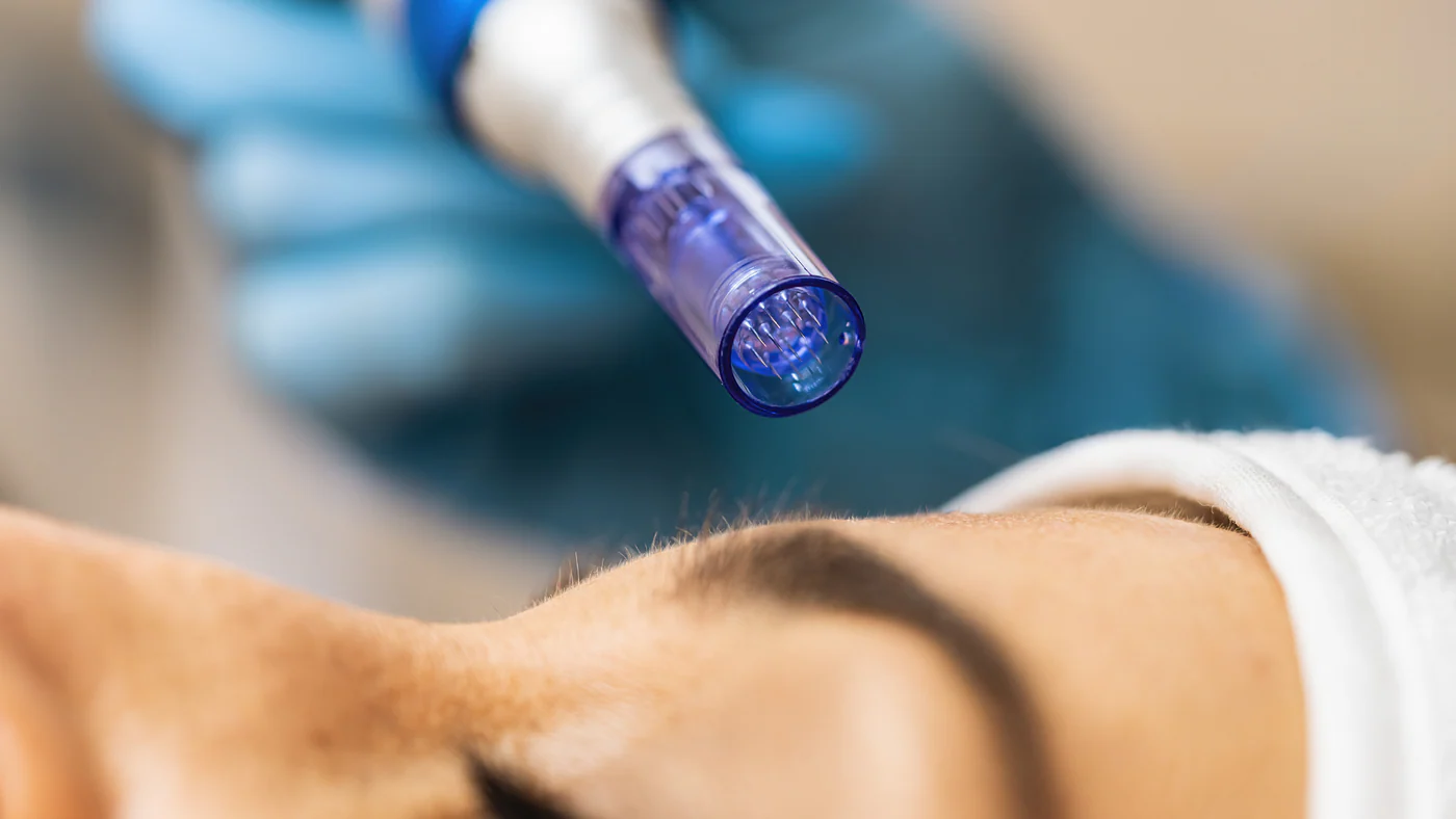 mezoterapia mikroigłowa cieszyn dermapen blizny