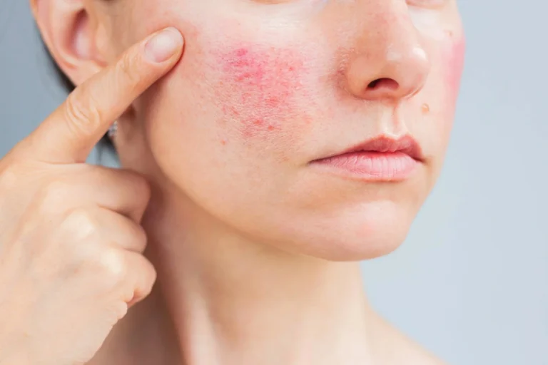 trądzik różowaty rosacea rumień skóra naczyniowa skóa reaktywna zabiegi na twarz cieszyn